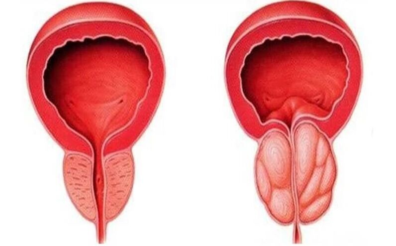 healthy and inflamed prostate with prostatitis